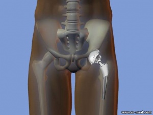 Проект постановления Правительства РФ о госрегулировании цен на медицинские изделия, имплантируемых в организм человека